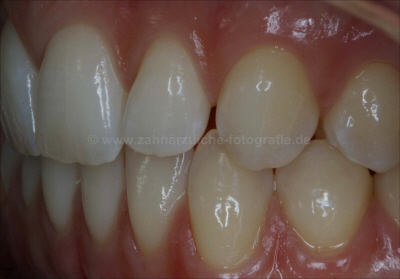 OK+UK schrg lateral links