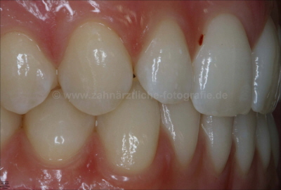 OK+UK schrg lateral rechts