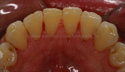 nach Zahnsteinentfernung